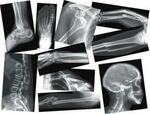 BROKEN BONES X RAYS